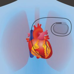 Pacemaker insertion codes are divided based on the surgical