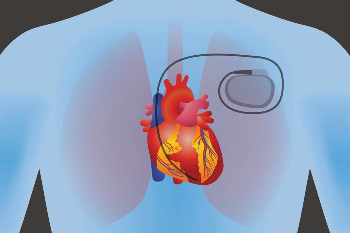 Pacemaker insertion codes are divided based on the surgical